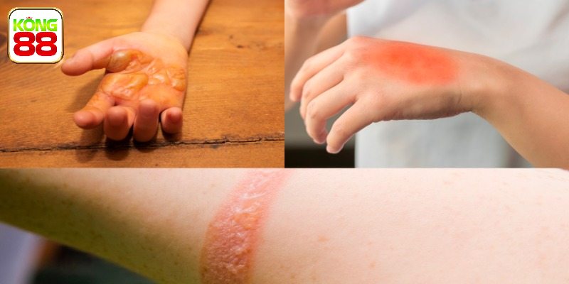 Chốt số nhanh những trường hợp mơ bị bỏng