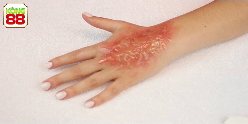 Mơ Thấy Bị Bỏng - Giải Mã Chi Tiết Những Con Số Liên Quan